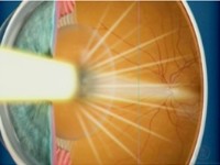 Oftalnova_oftalmologos_Barcelona_Cataratas_reflejo_luz