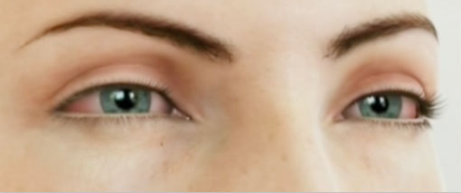 Oftalnova_oftalmologia_Barcelona_Ojo_seco