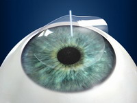 Reposición flap corneal Lasik