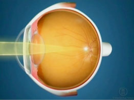 Miopia_Ojo_miope_Oftalnova_Oftalmologia_Barcelona