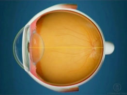 Miopia_cornea_normal_Oftalnova_oftalmologos_Barcelona