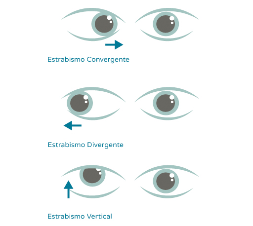 Oftalnova-oftalmologos-Barcelona-estrabismos-pediatricos