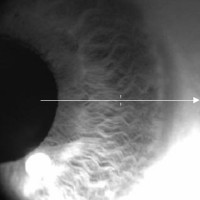 GONIOSCOPIA-Pruebas-oftalmologia-Oftalnova-Teknon-Barcelona-1-200x200