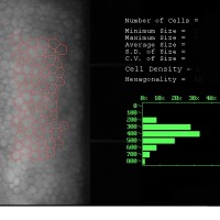 Microscopia-especular-recuento-endotelial-prueba-medica-ojos-oftalnova-barcelona-2-200x200