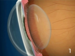 Cristalino con Vista Cansada – Presbicia1