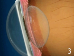 Cristalino con Vista Cansada – Presbicia 3