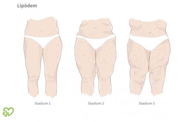 lipedema-estadios-teknon