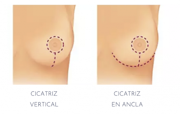 elevacion de mamas dra ana torres barcelona