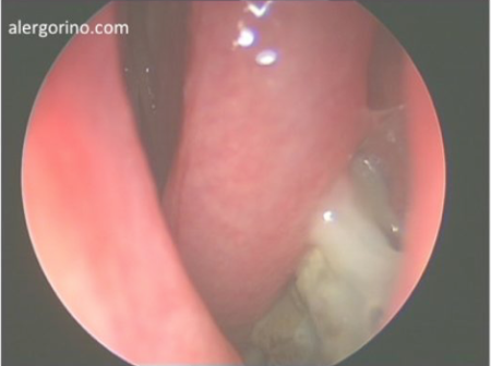 Sinusitis crónica