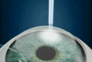 Oftlanova_Oftalmologos_Barcelona_Miopia_cirugia_refractiva_Laser_Lasik-300x204