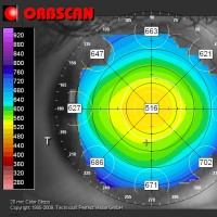 PAQUIMETRIA-prueba-diagnostica-grosor-cornea-oftalnova-barcelona