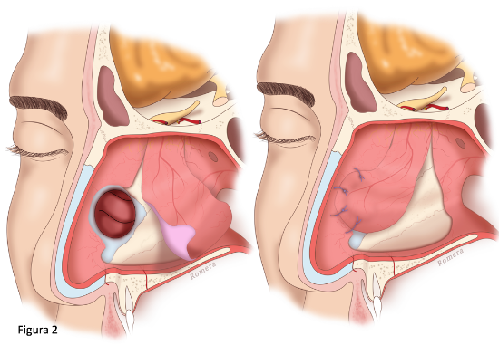 Colgajo de la arteria etmoidal anterior