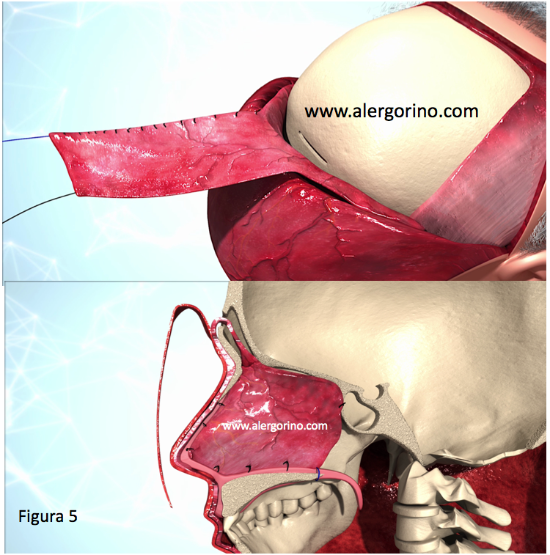 perforaciones septales