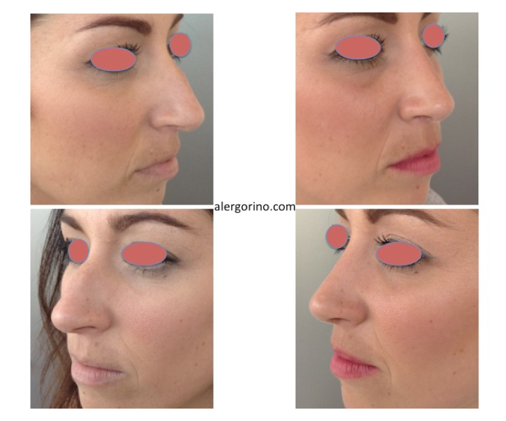 Rinoplastia dr Alobid