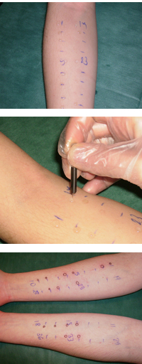 Prick test