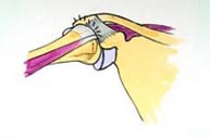 Tendinitis del supraespinoso