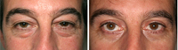Blefaroplastia_01