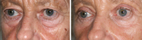 Blefaroplastia_03