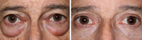 Blefaroplastia_04