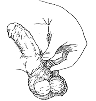 Separación del deferente.