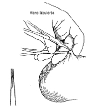 Punción de la luz del deferente.