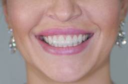 carillas de porcelana sonrisa después