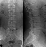 RX Columna lumbar