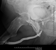 Uretrocistografía (Uretro-Cums)