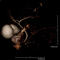 Colangio-pancreàtic-RM (RM de Pàncrees, vesícula i via biliar)
