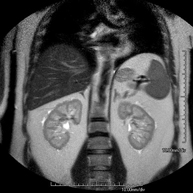 RM de Glàndules Suprarenals