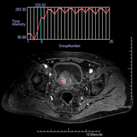 RM de Pròstata (pròstata endorectal + espectroscòpia)
