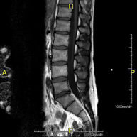 RM Columna Lumbar