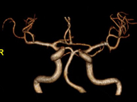 Angio-RM intracranial