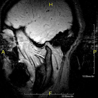 RM ATM (Articulació temporo-mandibular)