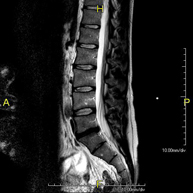RM de Columna lumbar