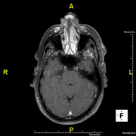 RM de Sins paranasals