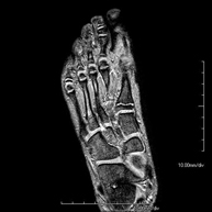 RM d'Ossos i articulacions