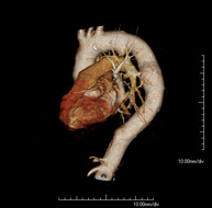 Angio-TC Aorta torácica