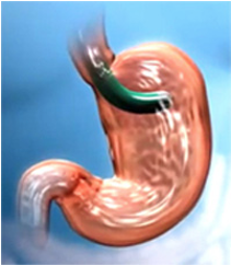 Endomanga endoscopica Teknon