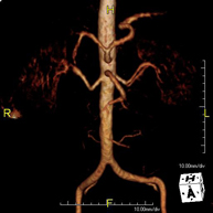 Angio-RM d'Aorta Abdominal