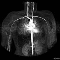 Angio-RM d'extremitats superiors