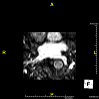 Angio-RM de venes pulmonars