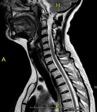 RM Columna cervical + dorsal