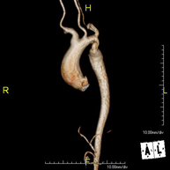 Angio-RM Aorta Torácica