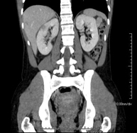 TC Abdomen
