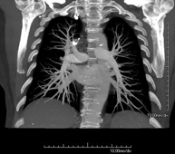 Angio-TC Arterias pulmonares