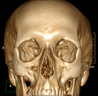 TC Macizo facial_1