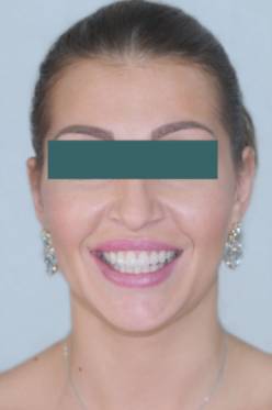 carillas de porcelana rostro entero después