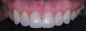 Carillas de porcelana dentadura superior