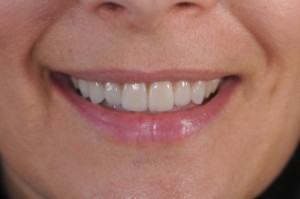 dientes centrados después